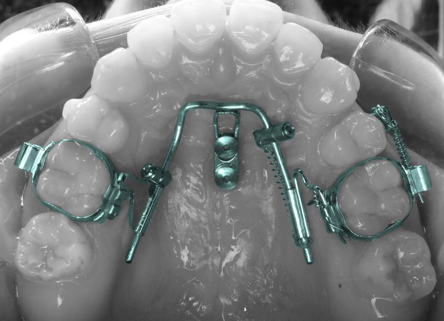 Benefit Distalisation