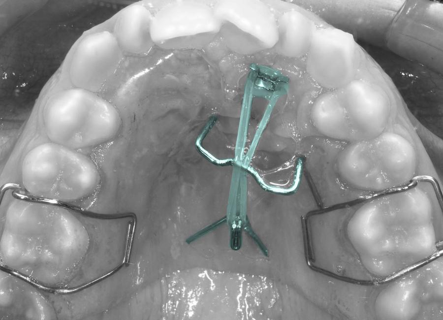 Désinclusion canine