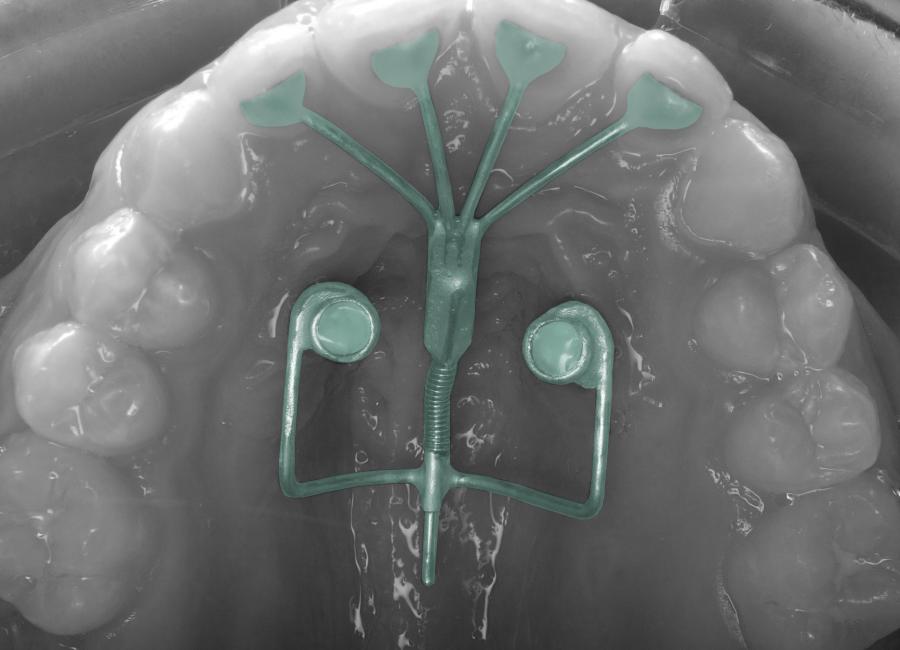 Stretching Maxillaire Mechanics sur ancrage osseux